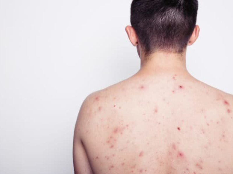 NHẬN BIẾT DẤU HIỆU HIV QUA 4 GIAI ĐOẠN
