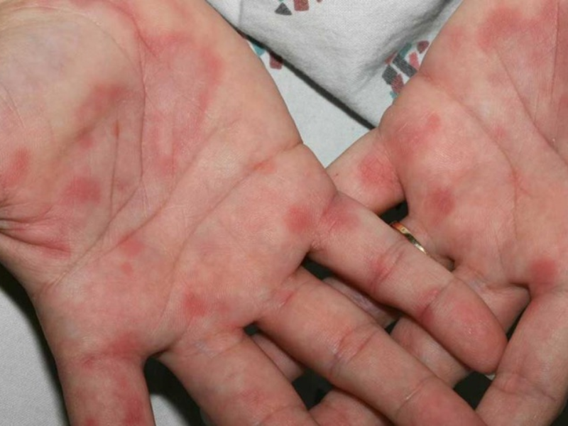 Dấu hiệu HIV giai đoạn đầu