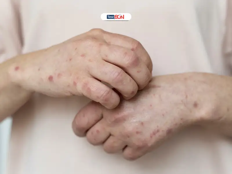Bệnh giang mai có tự khỏi được không