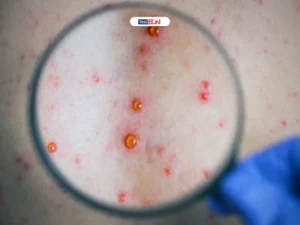 Giang mai là một bệnh lây truyền qua đường tình dục do xoắn khuẩn Treponema pallidum gây ra.
