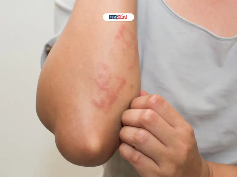 Triệu chứng HIV giai đoạn cuối là gì?