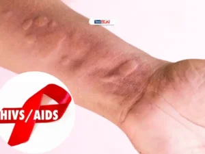 Nổi mề đay có thể xuất hiện dưới dạng các nốt mẩn đỏ, sưng tấy trên da.