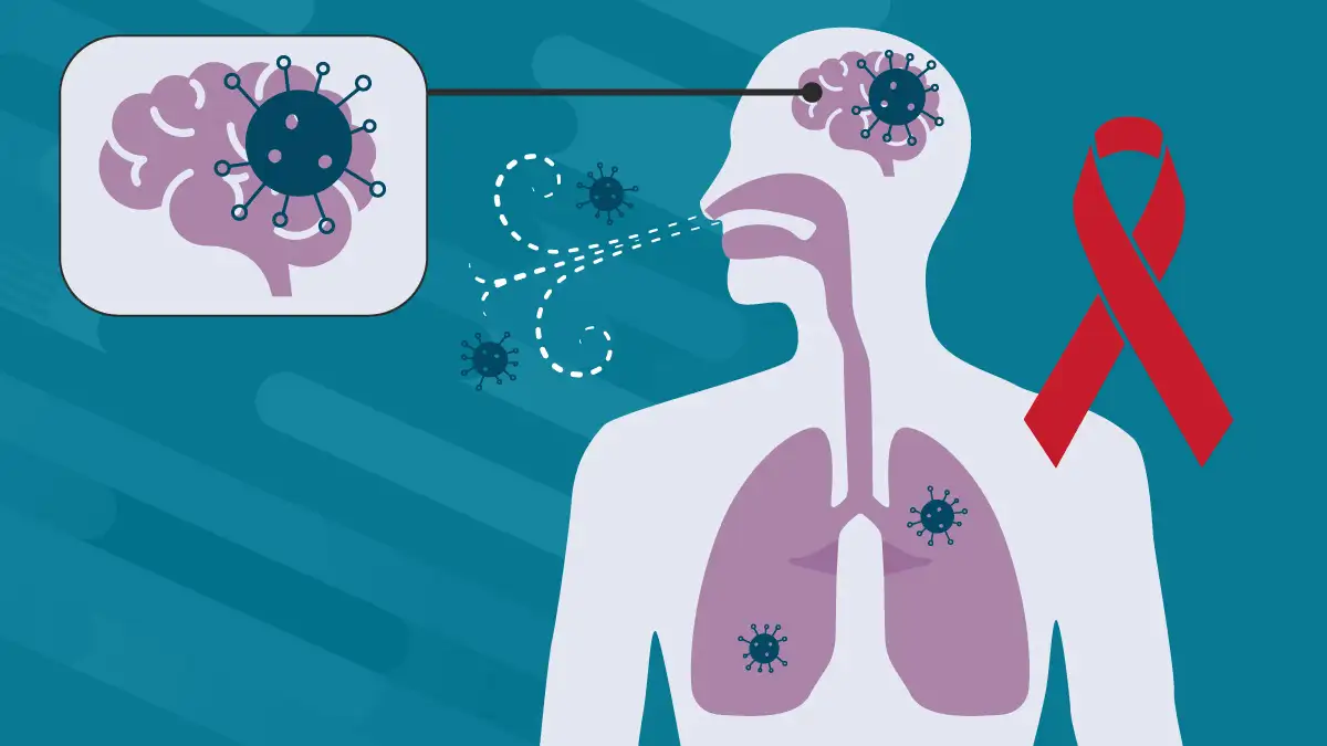 Bệnh nấm miệng HIV do Cryptococcosis gây biến chứng Viêm màng não