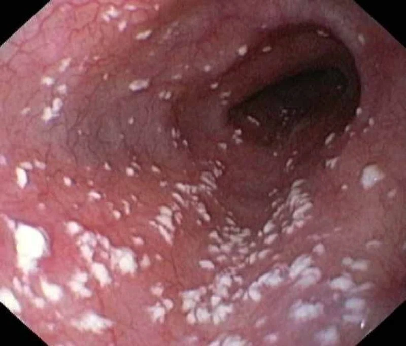 Nhiễm nấm Candidiasis gây ra niêm mạc miệng