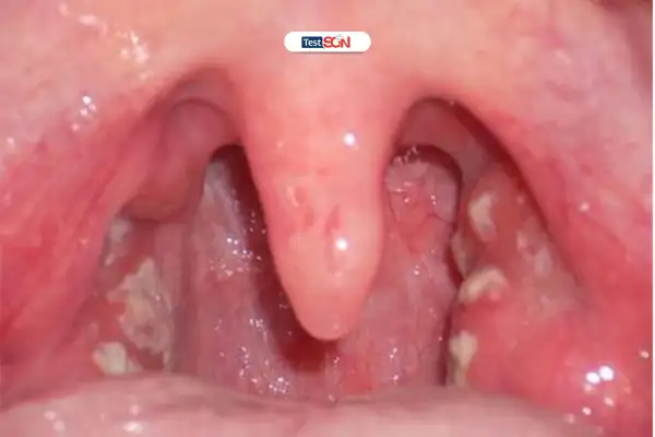 Nấm họng HIV không được điều trị có thể dẫn đến suy dinh dưỡng và các biến chứng nguy hiểm.