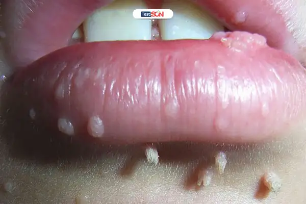 Chế độ ăn uống phù hợp giúp hỗ trợ quá trình điều trị nấm miệng.