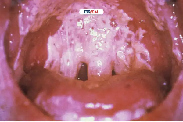 Số lượng CD4 quan trọng trong tiên lượng bệnh nấm miệng HIV