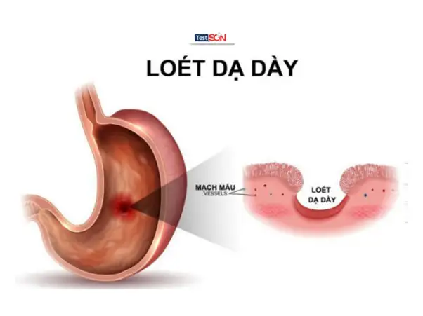 Tiêu chảy kéo dài làm suy yếu hệ miễn dịch, tăng nguy cơ mắc các bệnh cơ hội khác.