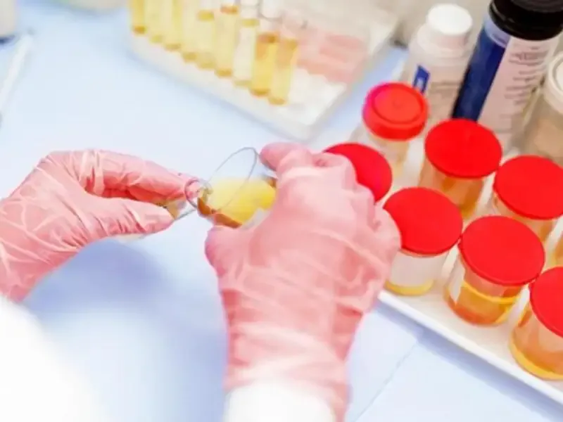 Xét nghiệm nước tiểu có phát hiện HIV không