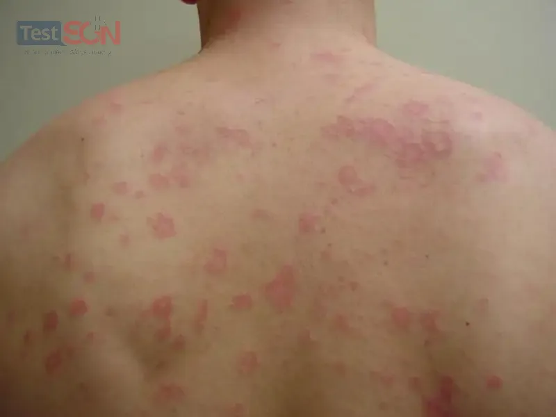 Bệnh giang mai ở nam: Nguyên nhân, dấu hiệu và cách điều trị