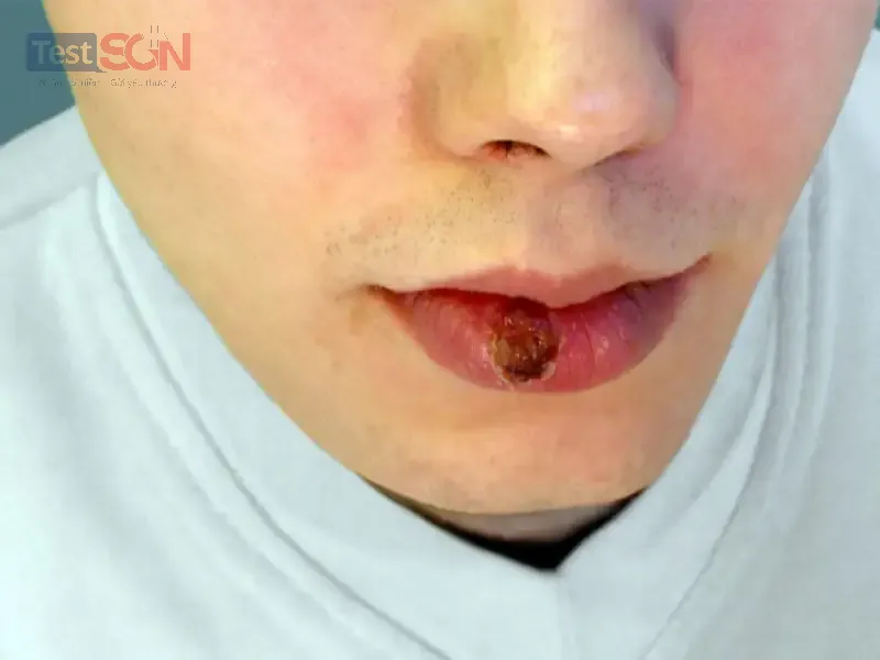 Bệnh giang mai ở nam: Nguyên nhân, dấu hiệu và cách điều trị