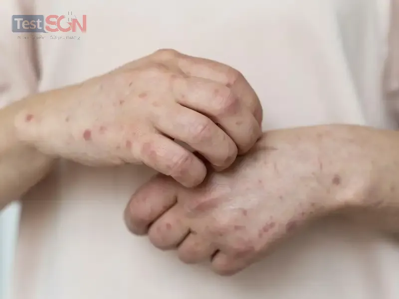 Bệnh giang mai ở nam: Nguyên nhân, dấu hiệu và cách điều trị
