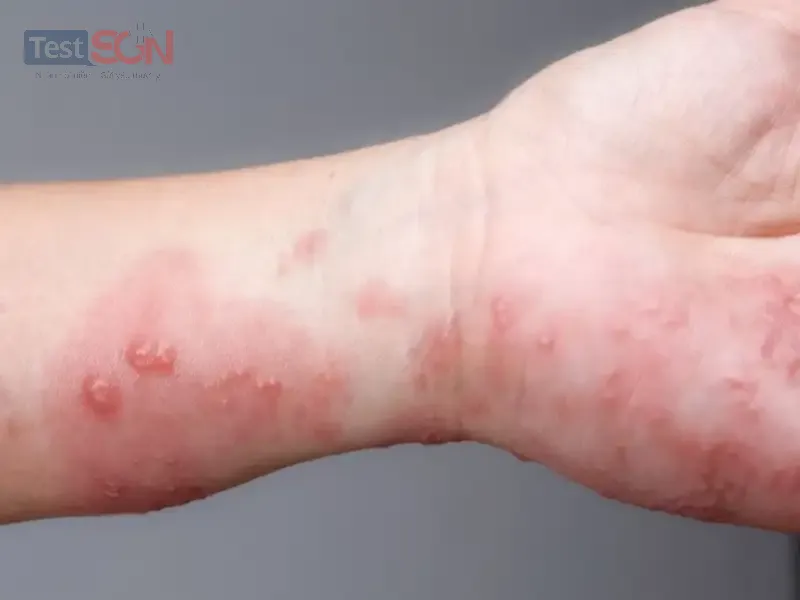 Bệnh giang mai ở nam: Nguyên nhân, dấu hiệu và cách điều trị