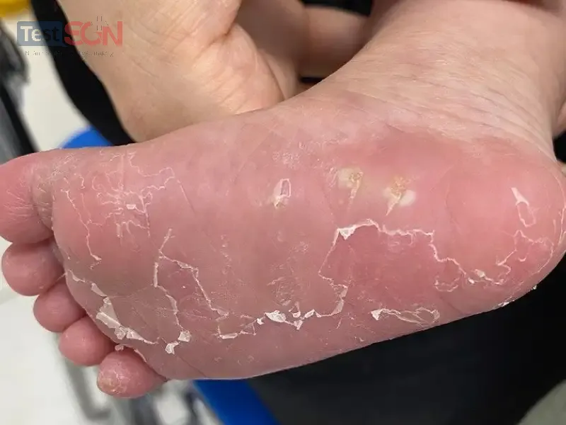 Giang mai bẩm sinh: Dấu hiệu, triệu chứng, và cách điều trị