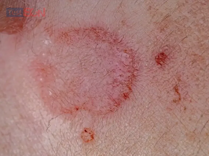 Giang mai giai đoạn 1 (đầu): Dấu hiệu, chẩn đoán và cách điều trị