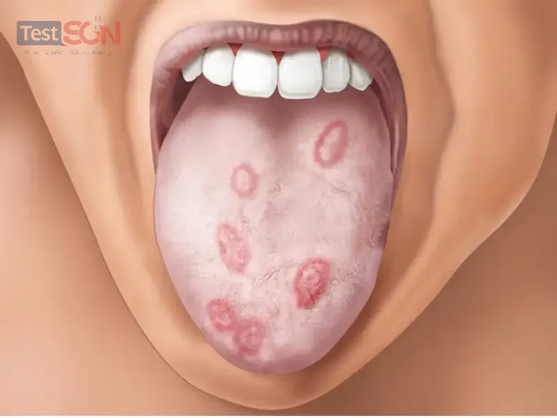 Giang mai giai đoạn 1 (đầu): Dấu hiệu, chẩn đoán và cách điều trị