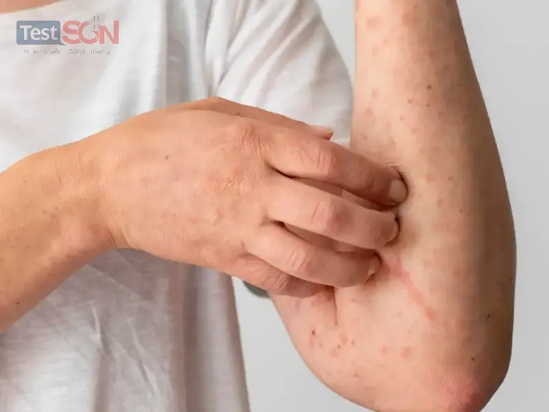 Giang mai giai đoạn 1 (đầu): Dấu hiệu, chẩn đoán và cách điều trị