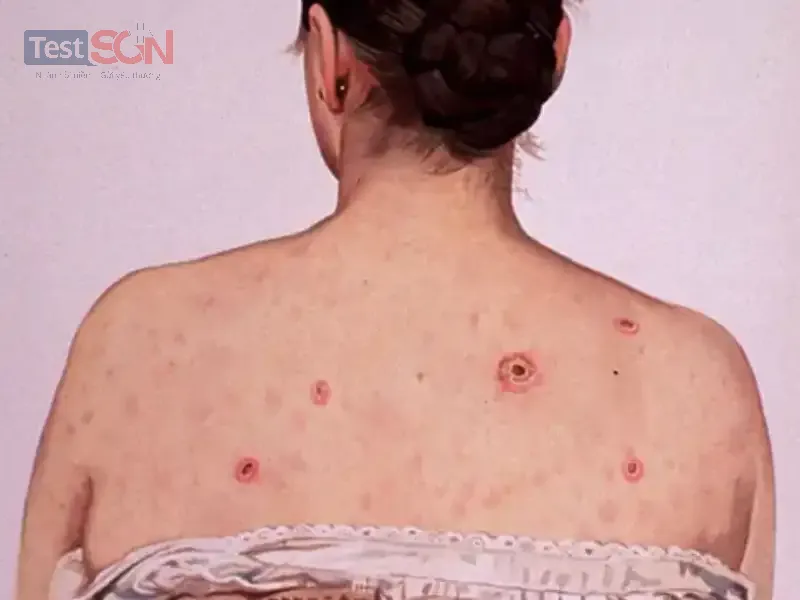 Giang mai ở nữ giới: Nguyên nhân, dấu hiệu và cách điều trị