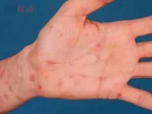 Bệnh lậu và giang mai có giống nhau không?