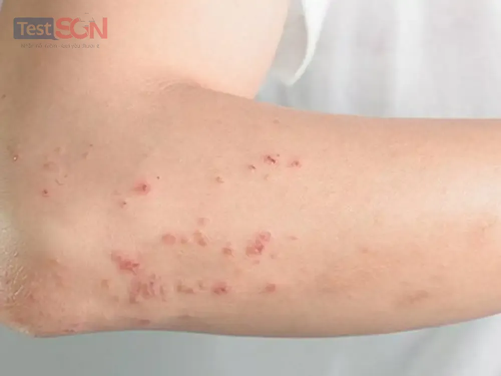 Các tác hại của HIV và hậu quả HIV đến sức khỏe con người