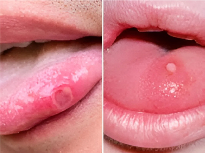 BJ có bị sùi mào gà không