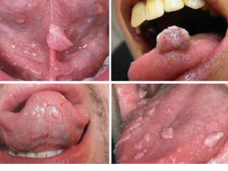 Triệu chứng khi mắc sùi mào gà do BJ