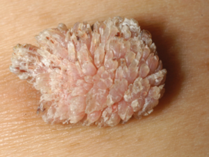 Bệnh giống sùi mào gà