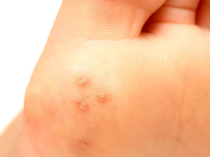 U nhú tiền đình Papillomatosis