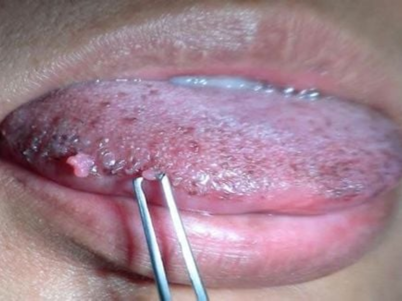 Phòng ngừa sùi mào gà