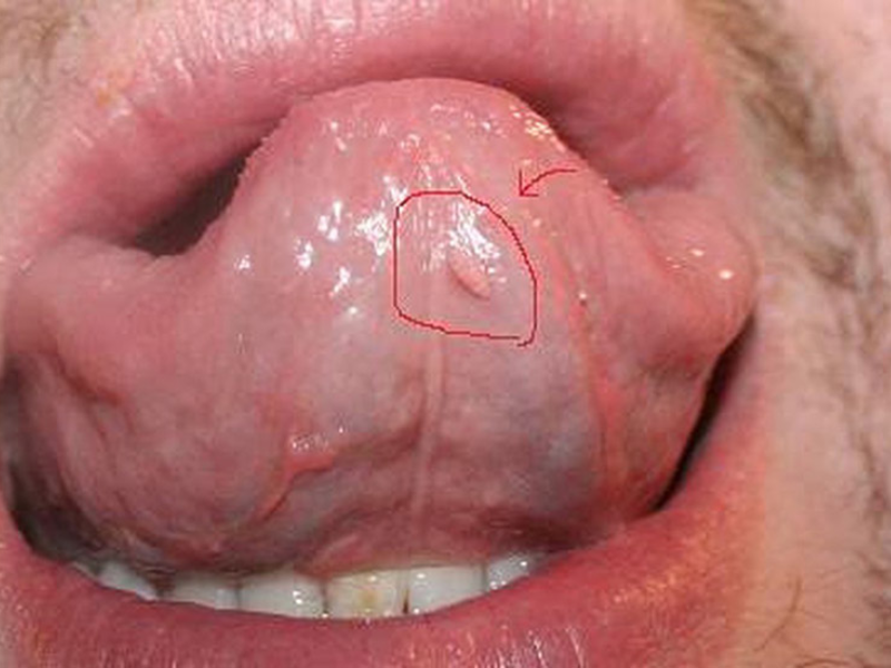 Sùi mào gà ở miệng là gì? 