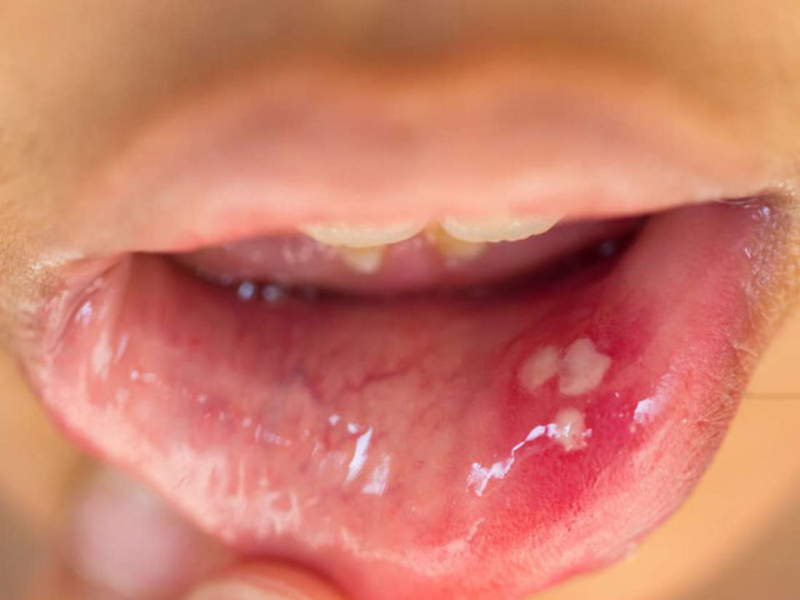 Dễ biến chứng thành ung thư nếu không chữa trị dứt điểm 