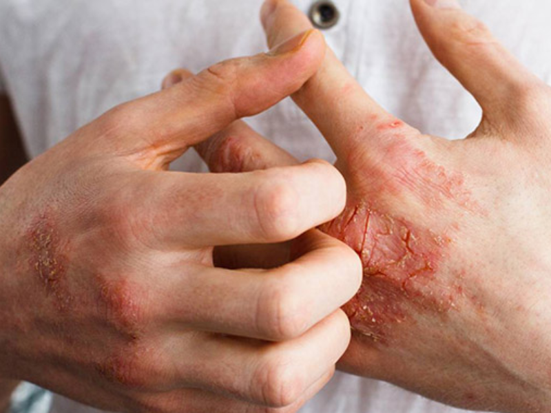 Bệnh xã hội là gì? 
