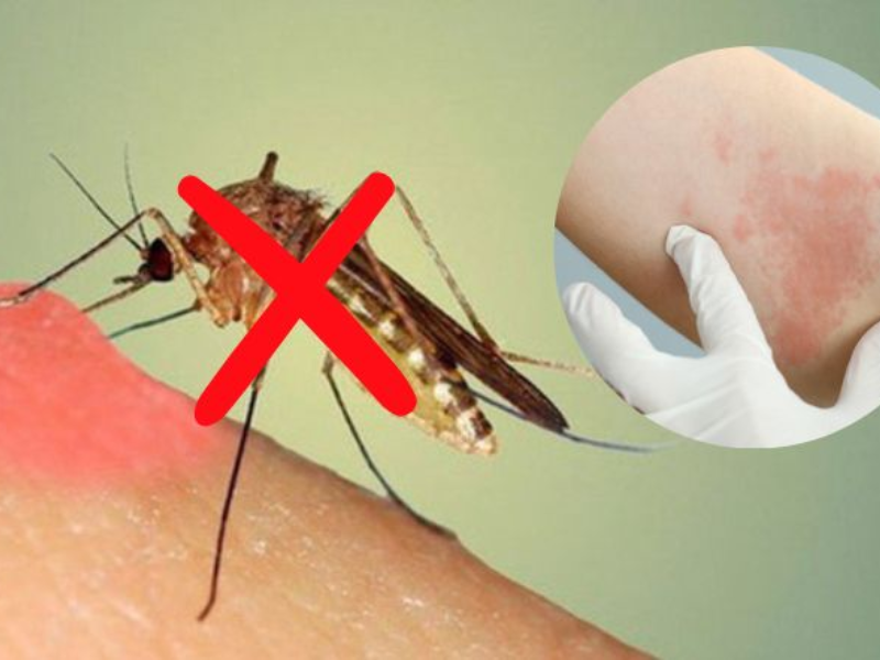 HIV có lây qua đường muỗi đốt không​