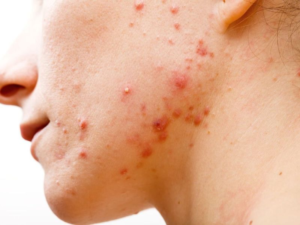 Nên làm gì khi cơ thể nổi mụn do HIV