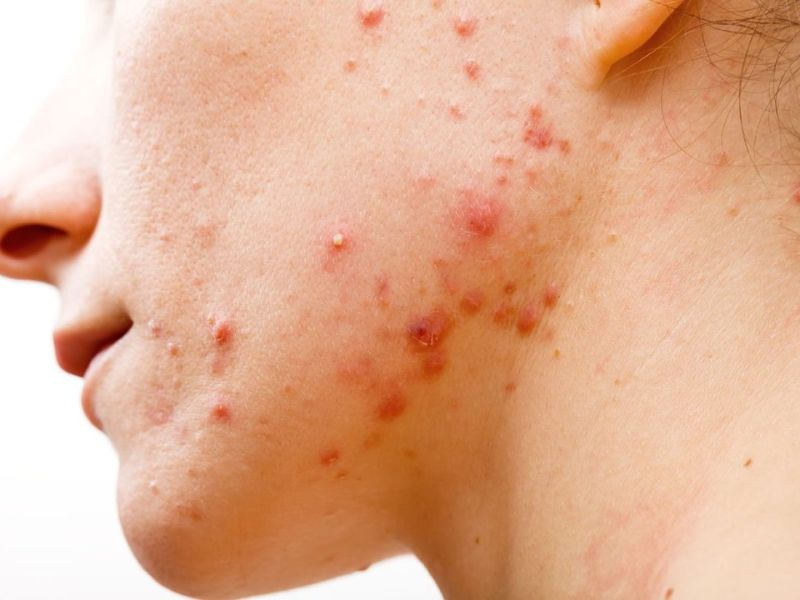 Nên làm gì khi cơ thể nổi mụn do HIV