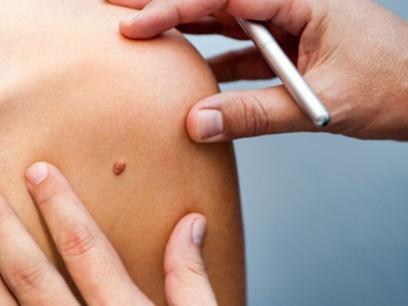 Đặc điểm của mụn HIV