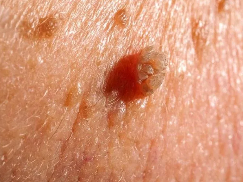 Mụn cóc khác với sùi mào gà như thế nào? 