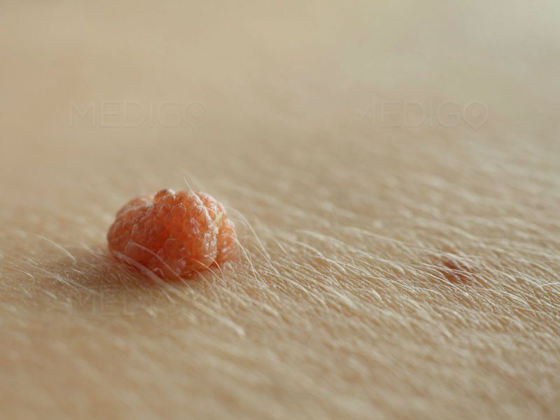 Virus HPV là gì?