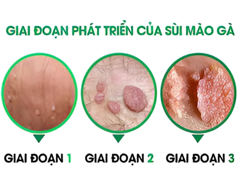 Giai đoạn phát triển của sùi mào gà