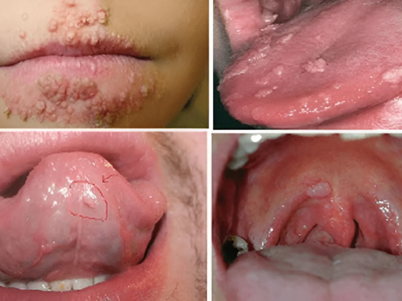 Hình ảnh sùi mào gà 1