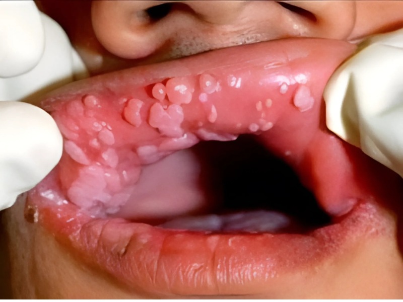 Hình ảnh sùi mào gà 3