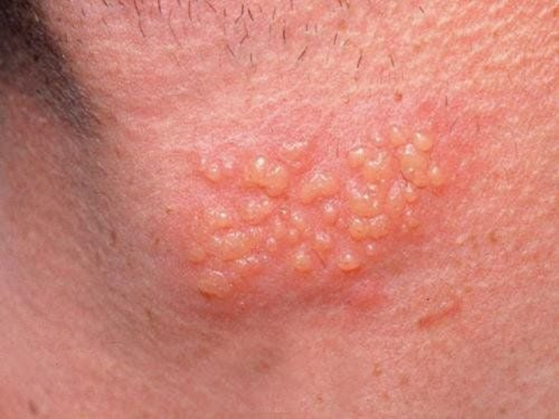 Các đường lây truyền của bệnh sùi mào gà 