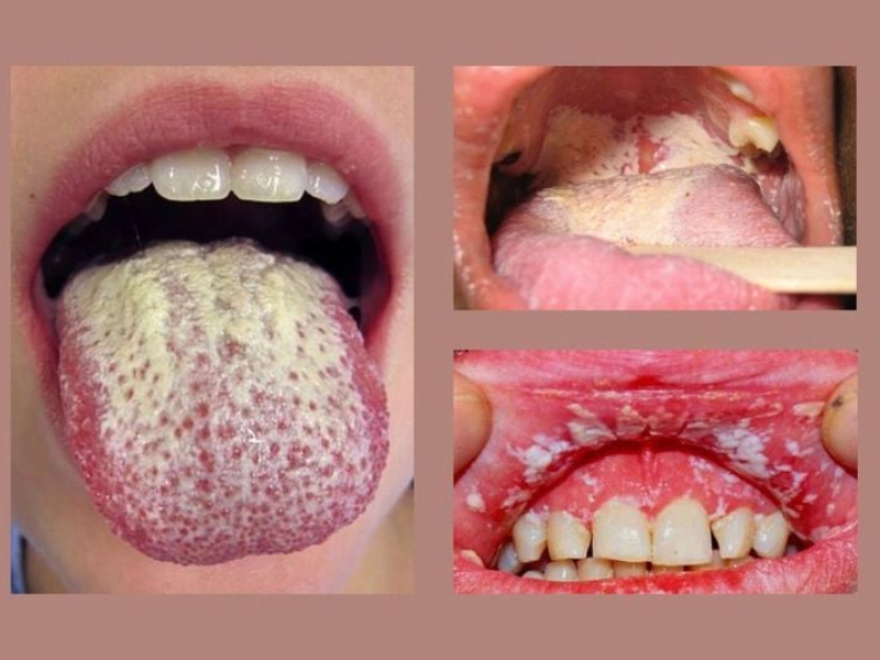 Thời gian cửa sổ HIV