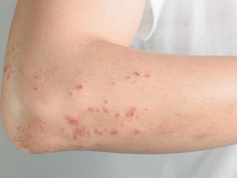 HIV không lây qua tiếp xúc hàng ngày
