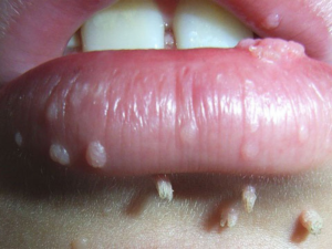 Sùi mào gà ở miệng trẻ em