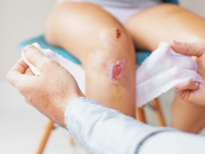 Vết thương lâu lành có phải bị HIV