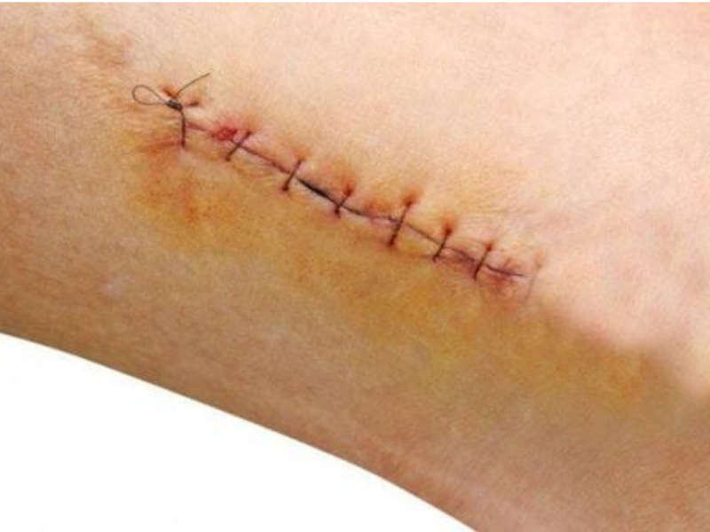 Khả năng lây nhiễm qua vết thương hở của người nhiễm HIV 