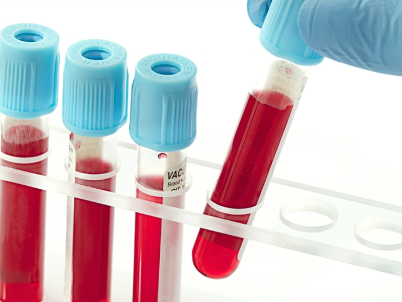 Vì sao cần đến xét nghiệm Elisa HIV? 